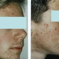 Acne grading - face, grade 3+4