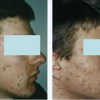 Acne grading - face, grade 5+6