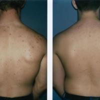 Acne grading - trunk, grade 2+1
(please note the…