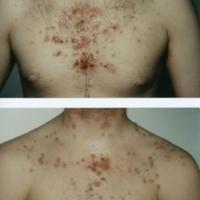 Acne grading - trunk, grade 6+5
(please note the…