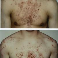 Acne grading - grade 8+7
(please note the milder…