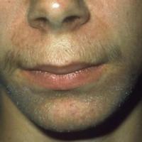 Irritant dermatitis secondary to topical acne…