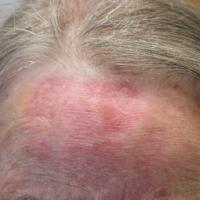 
	Same patient eight weeks after treatment had…
