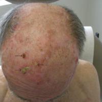 Actinic keratosis with field changeA number of…