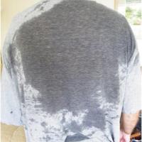 
	Compensatory sweating following ETS