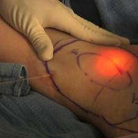 
	Laser sweat ablation for hyperhidrosis of the…