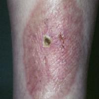 
	Ulcerating necrobiosis lipoidica