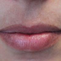
	Post-treatment

	Not all patients will respond…