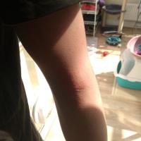 
	A flash can light up the skin unevenly