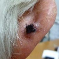 
	Crust and scab obscure the lesion