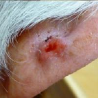 
	Crust and scab removed&nbsp;