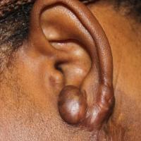 
	Keloid scar pre-treatment