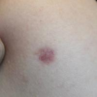 
	Telangiectasia post treatment with…