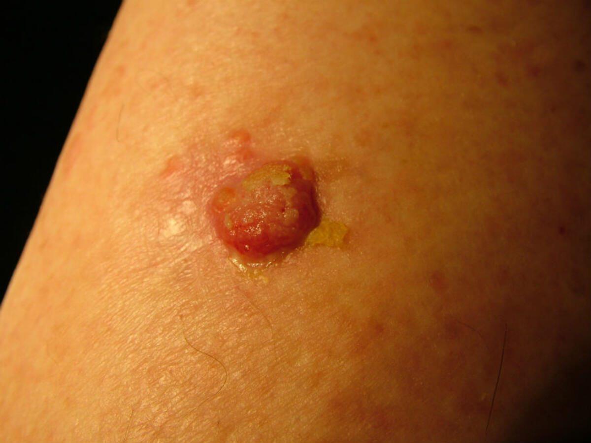Scaly Rash Pcds Dermoscopic assessment