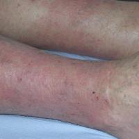 Gravitational eczema