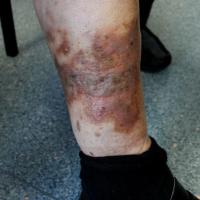Gravitational eczema with marked haemosiderin staining