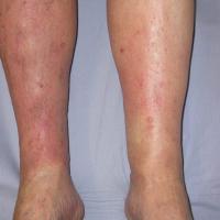 Gravitational eczema