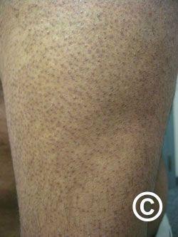 Keratosis pilaris