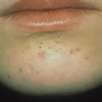 Acne vulgaris