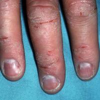 Hand eczema