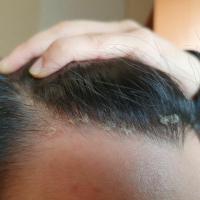 Scalp psoriasis in the hairline