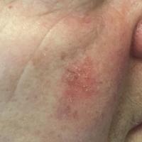 Grade 1 actinic keratosis - better felt than seen