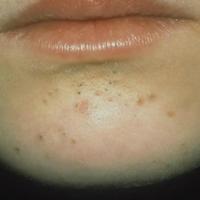 Acne - comedones
