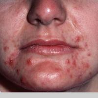Acne - localised papules and pustules