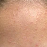 Acne - mild inflammation
