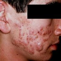 Acne - nodules and scarring