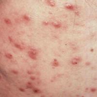 Acne - papules and pustules