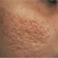 Acne scarring