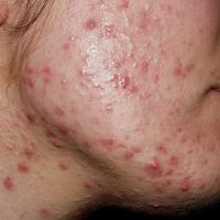 Acne secondary to Polycystic Ovarian Syndrome (copied with kind permission - Dermatoweb)