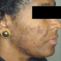 Acne with papules some pustules and marked hyperpigmentation
