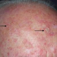 Actinic keratoses with field damage