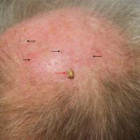 Actinic keratoses with field damage