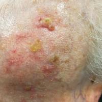 Actinic keratoses - severe, possible early SCC top of image