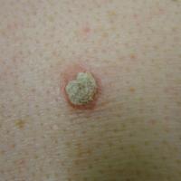 Grade 2 actinic keratosis