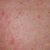 Cholinergic urticaria - an inducible urticaria