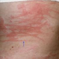 Dermographism - common in urticaria, sometimes this is the only feature