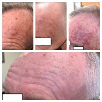Efudix treatment 10