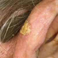 Grade 2 actinic keratosis