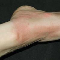 Solar urticaria (copied with kind permission - Dermatoweb)