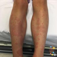 Urticaria 30