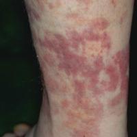 Vasculitic urticaria