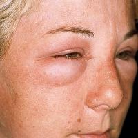 Angioedema (copied with permission - Dermatoweb)