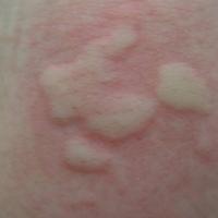 Chronic spontaneous urticaria - typical wheal and flare