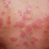 Chronic spontaneous urticaria - red wheals (copied with kind permission - Dermatoweb)
