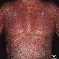 Erythrodermic psoriasis
