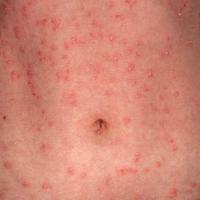 Guttate psoriasis